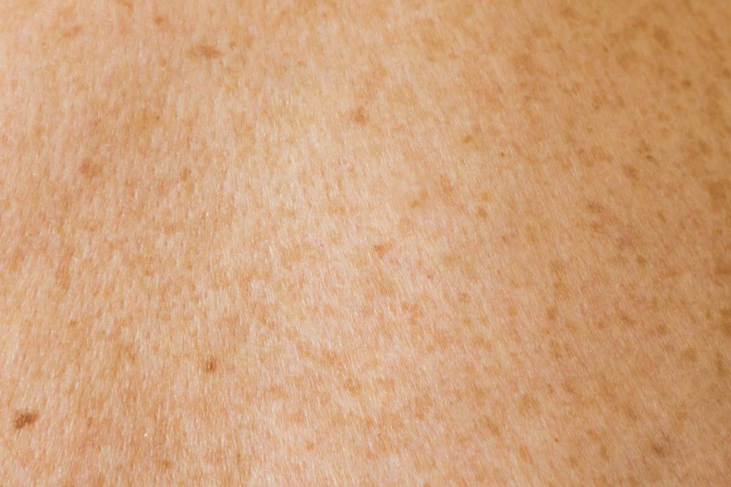 Human skin texture with freckles