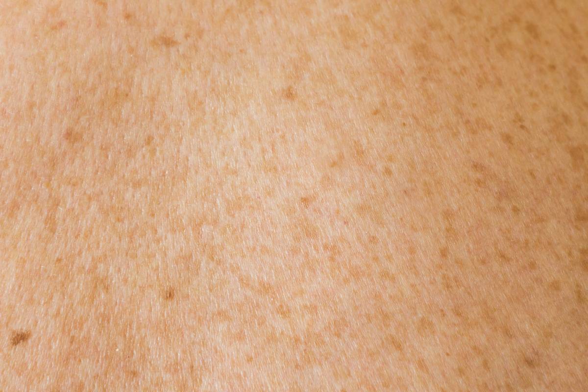 Human skin texture with freckles